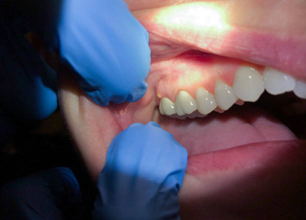 Best Emergency Dental Extractions in Langhorne, PA